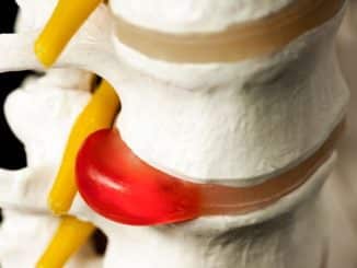 5 Keys to Safe Exercises for Herniated Disc Clients (Trainers Must Read): Stop Making These Mistakes!- safe exercises for herniated disc