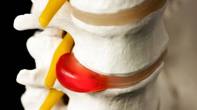 5 Keys to Safe Exercises for Herniated Disc Clients (Trainers Must Read): Stop Making These Mistakes!- safe exercises for herniated disc 5 Keys to Safe Exercises for Herniated Disc Clients (Trainers Must Read): Stop Making These Mistakes!- safe exercises for herniated disc