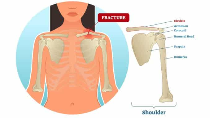 What is a Broken Collarbone