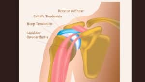 3 Ways the Rotator Cuff Could be Causing Your Client's Shoulder ...