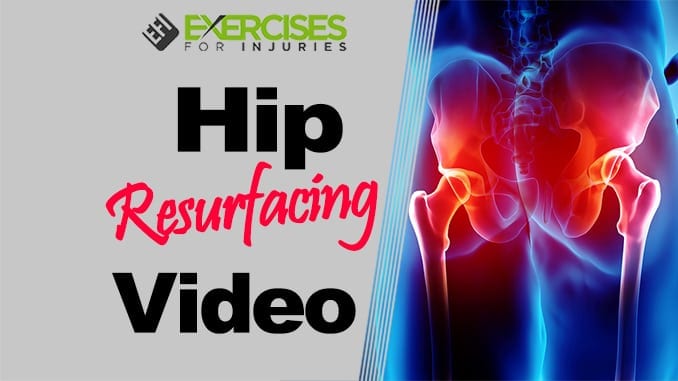 Hip Resurfacing Video