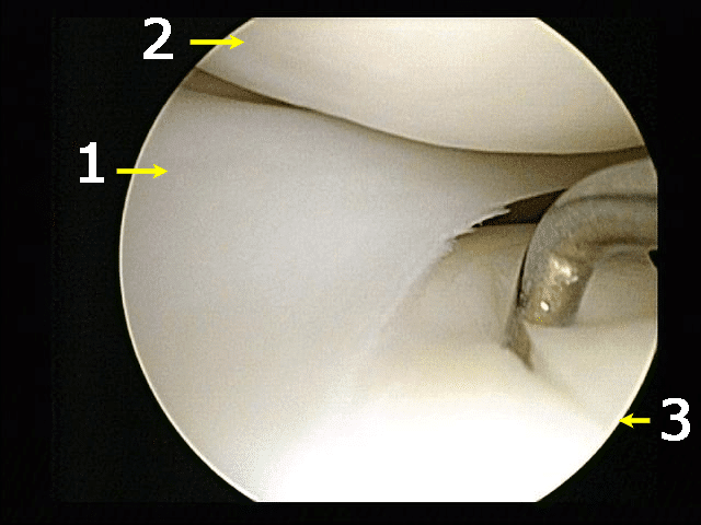 Lateral_meniscus_damaged_tibial_cartilage-legend