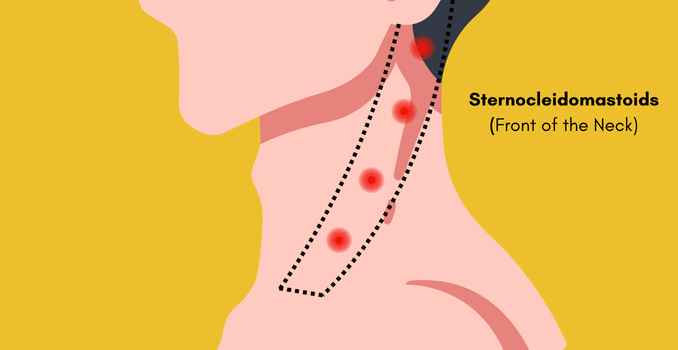 Sternocleidomastoids - migraine trigger points massage