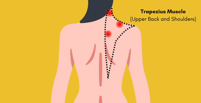 Trapezius Muscle (Upper Back and Shoulders) - migraine trigger points massage