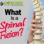 What is a Spinal Fusion?