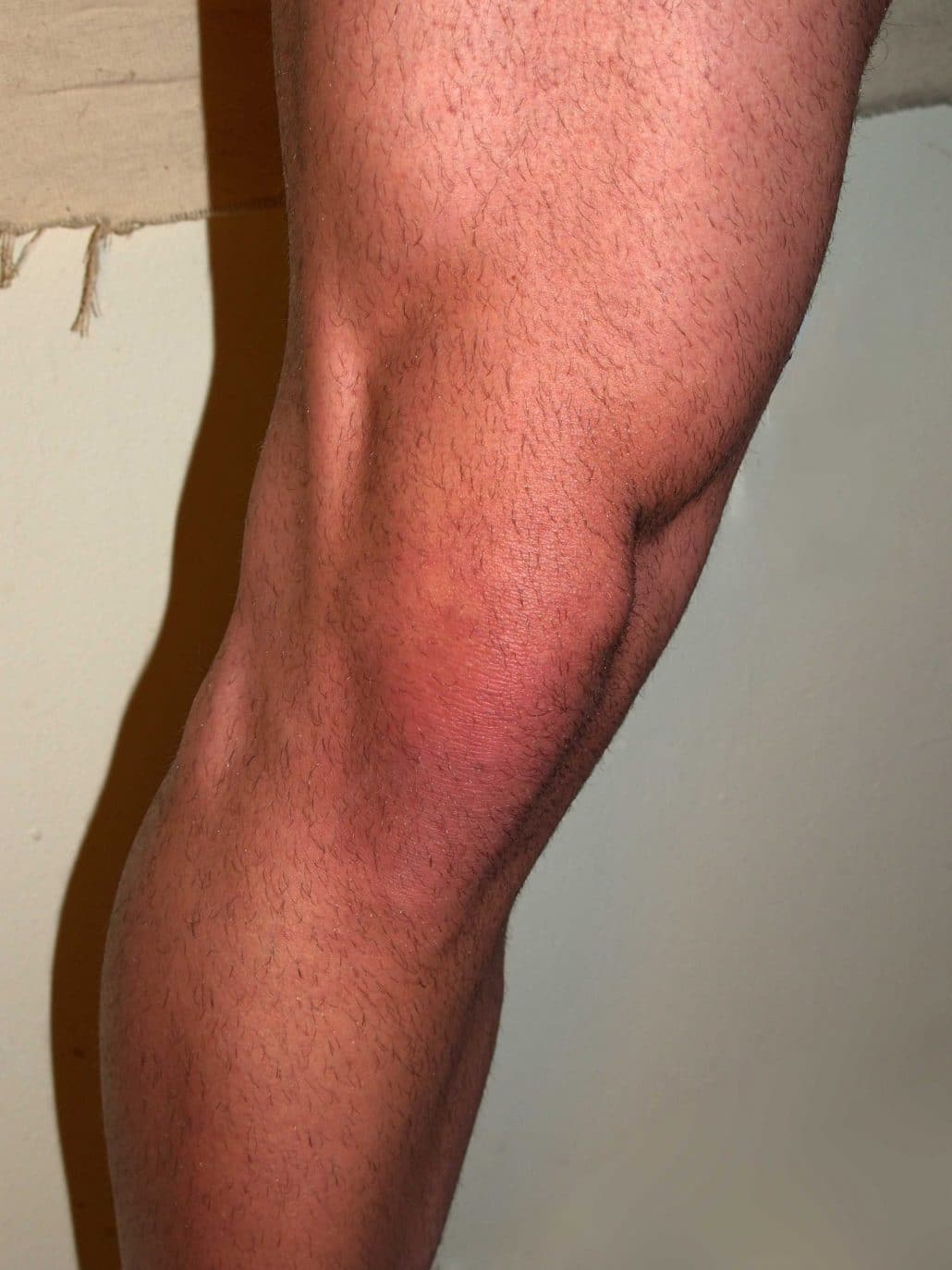 Overview of Knee Pain
