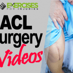 ACL Surgery Videos