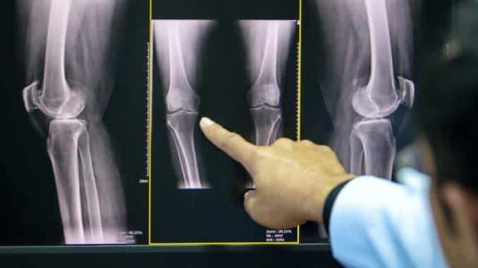 knee problem x-ray