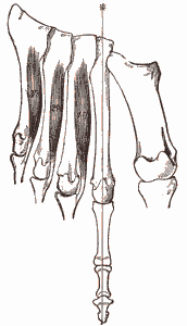 Plantar Fasciitis