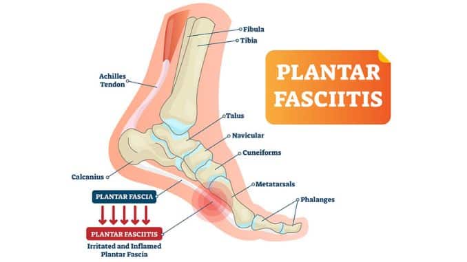 Plantar-Fasciitis-Vector