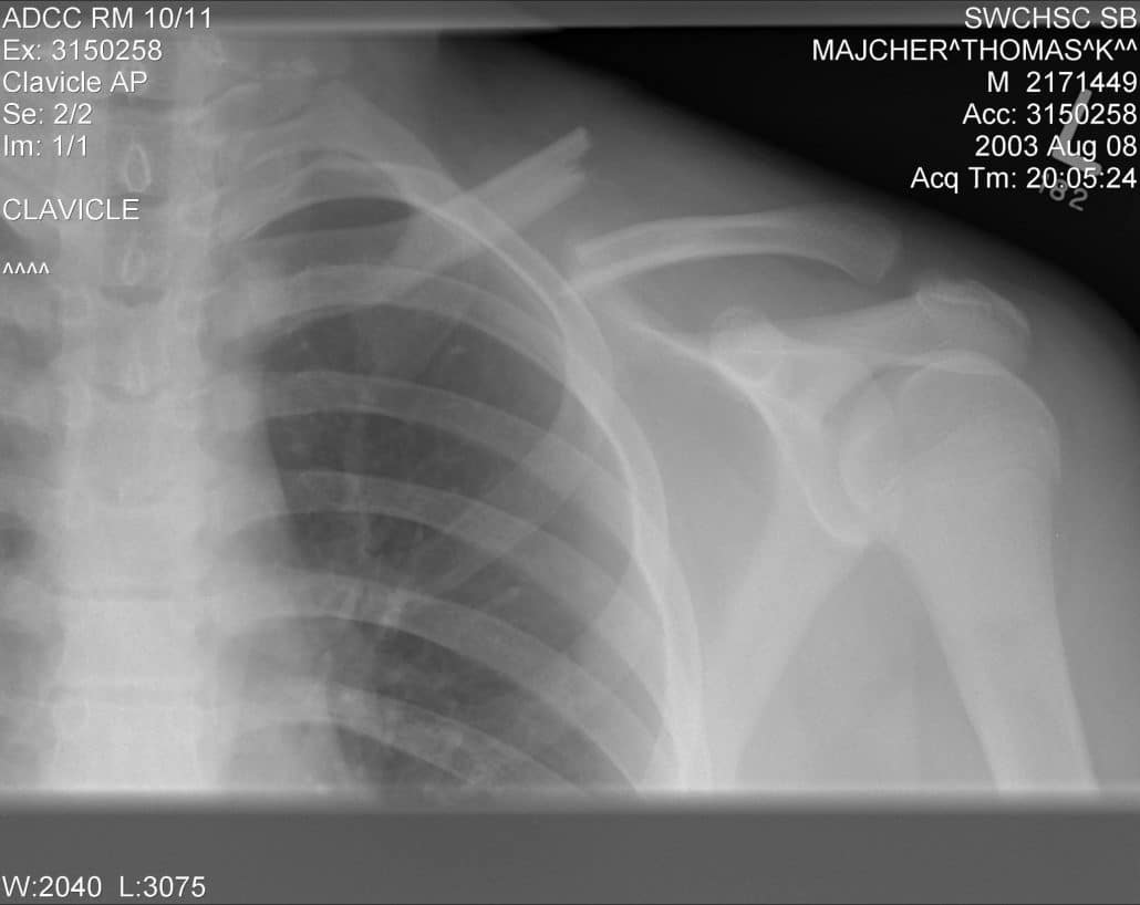 Clavicle_fracture_left