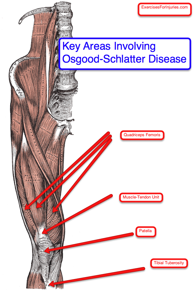 Osgood-Schlatter-Disease