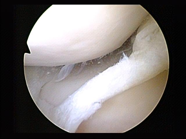 Tear of medial meniscus