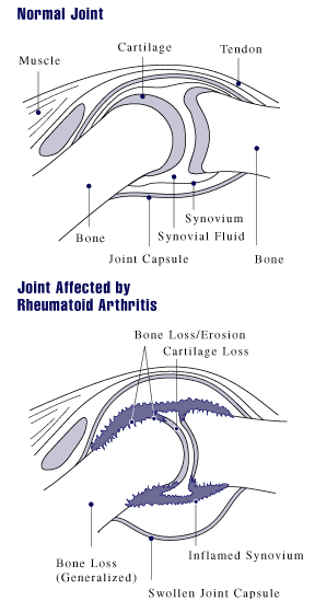 Rheumatoid_arthritis_joint