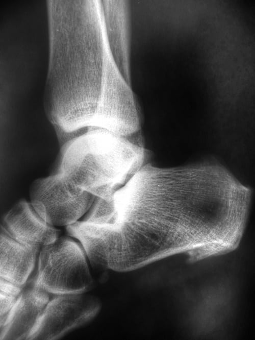 foot x ray