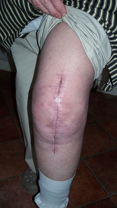 Total knee replacment scar