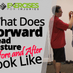 What Does Forward Head Posture Before and After Look Like