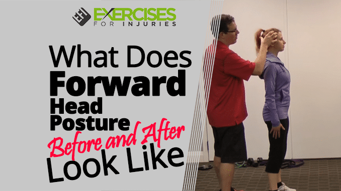What Does Forward Head Posture Before and After Look Like