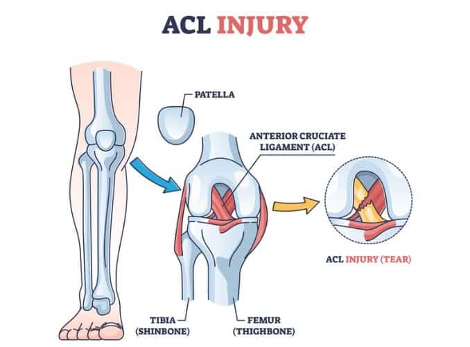 Anterior Cruciate Ligament