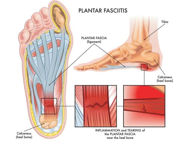 Plantar Fasciitis