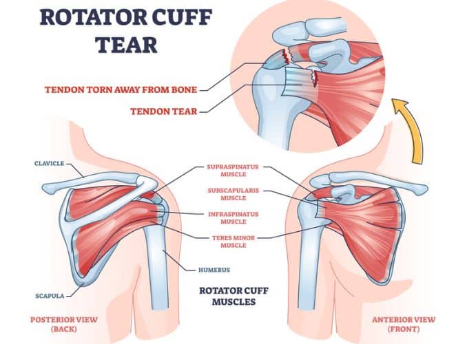 Rotator Cuff Tear