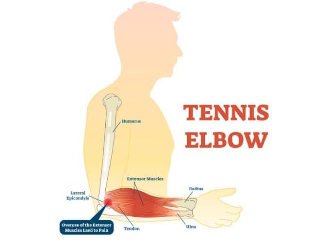 Tennis Elbow