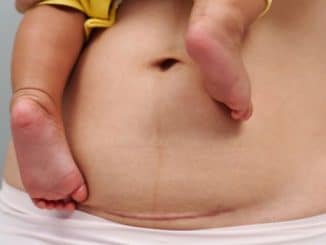 Bounce Back After Baby! The Safe, Smart Way to Exercise After a C-Section- exercise after c section