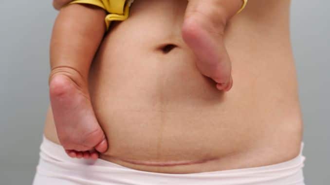 Bounce Back After Baby! The Safe, Smart Way to Exercise After a C-Section- exercise after c section