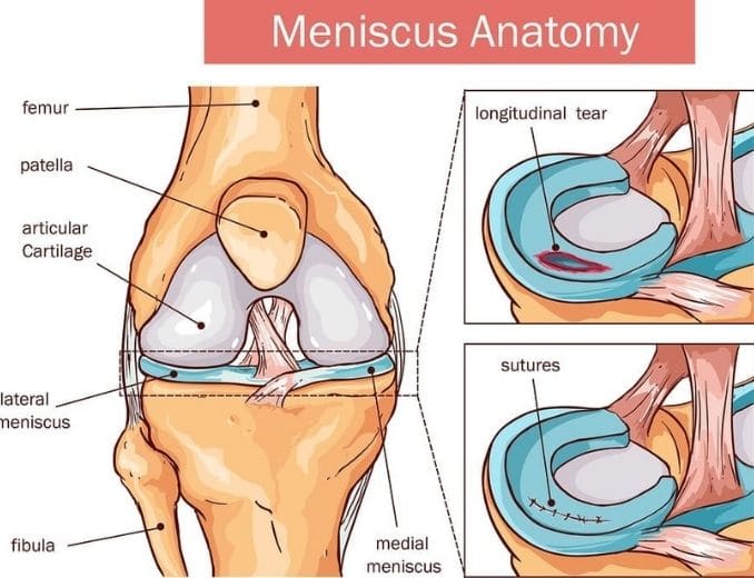 Meniscus Anatomy-Meniscus Tear Causes and Natural Treatments