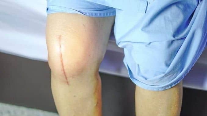 knee-Scar