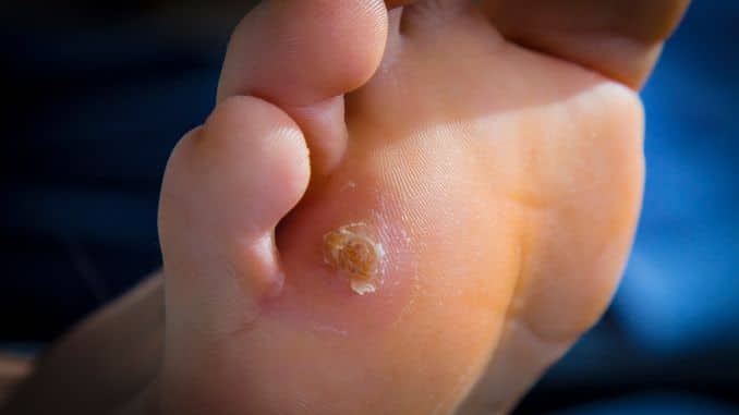 Corns and Calluses- high heels foot damage