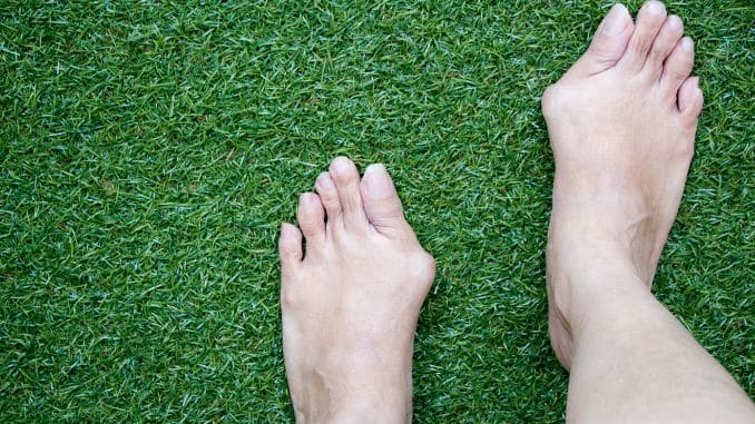 Bunions- high heels foot damage
