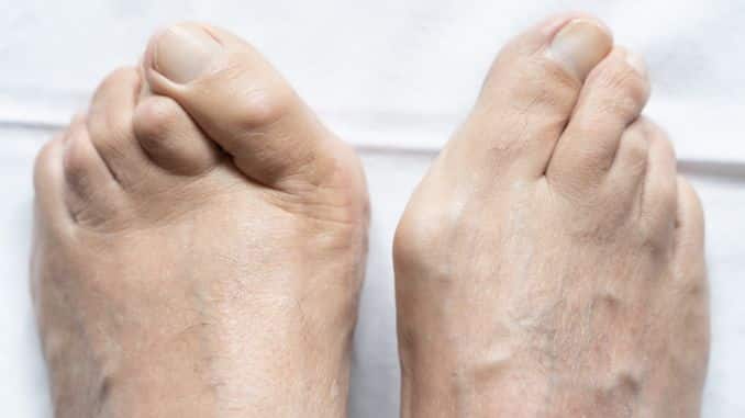 Hammertoes & Claw Toes- high heels foot damage