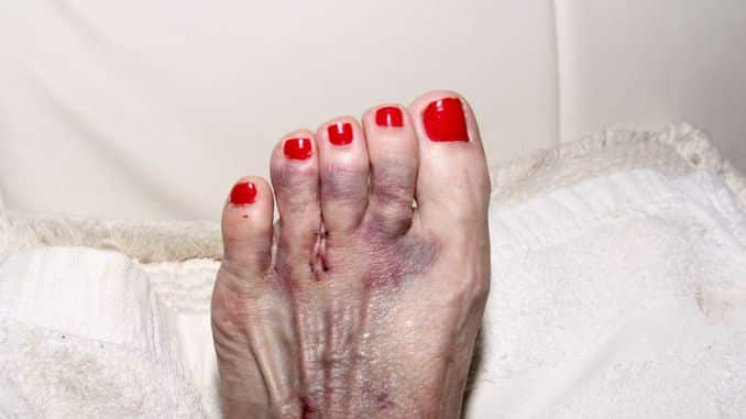 Morton’s Neuroma- high heels foot damage