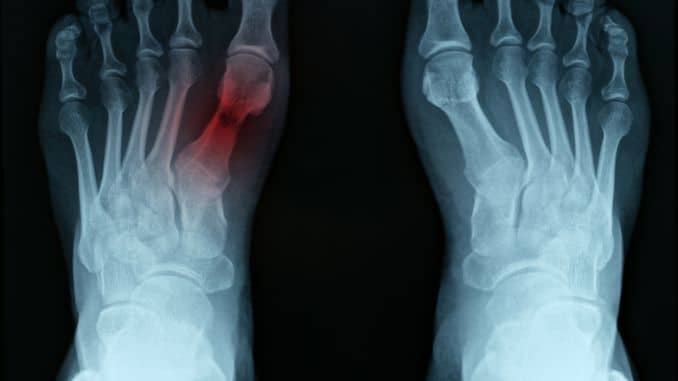 Stress Fractures
