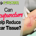 Can Acupuncture Help Reduce Scar Tissue?