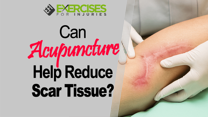 Can Acupuncture Help Reduce Scar Tissue