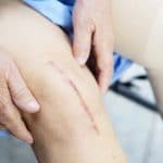 Knee Replacements – Benefits, Risks & Recovery