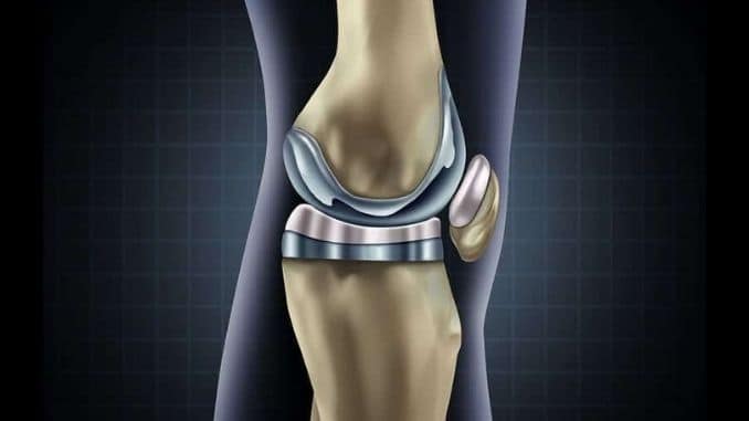 Total Knee Replacement - Knee Replacement Benefits and Risks