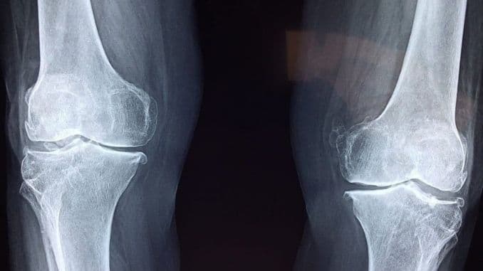 knee-replacement - Recover From Knee Replacement Surgery