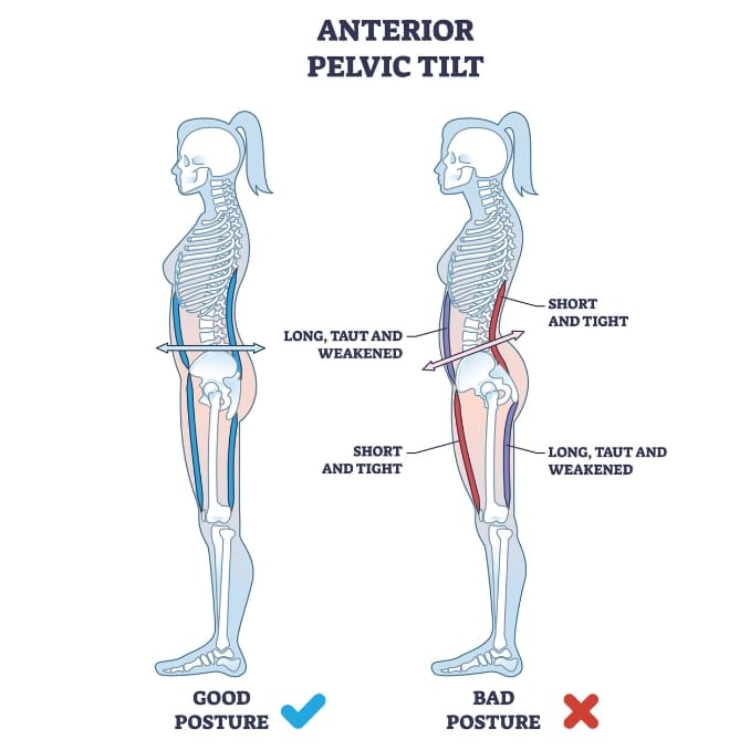 Understanding Anterior Pelvic Tilt