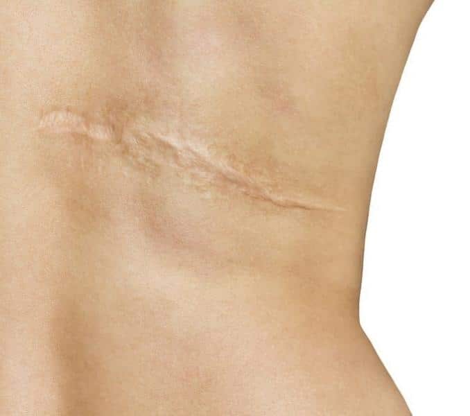 scar tissue on back
