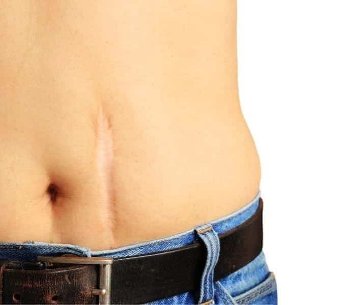scar tissue on stomach
