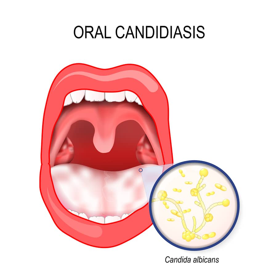 vector-oral-candidiasis-oral-thrush-that-occurs