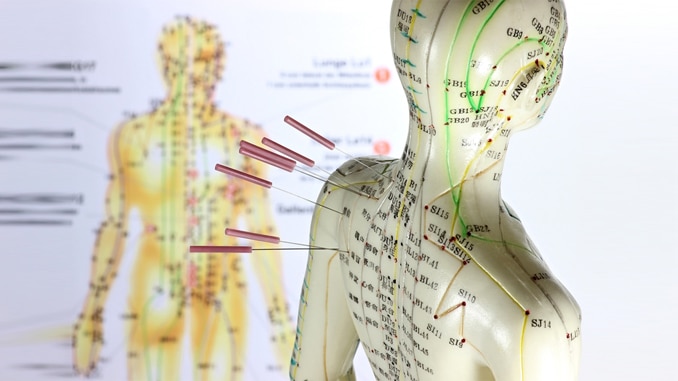 Should You Try Acupuncture