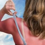 14 Natural Ways to Treat a Sunburn