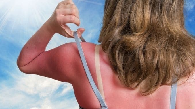 14 Natural Ways to Treat a Sunburn