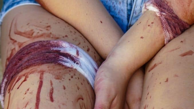 Bandage-body-fake-blood-painful-wound