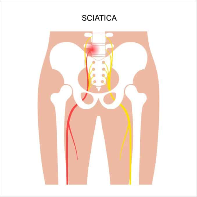 Sciatica - Low Back Pain Dos and Donts