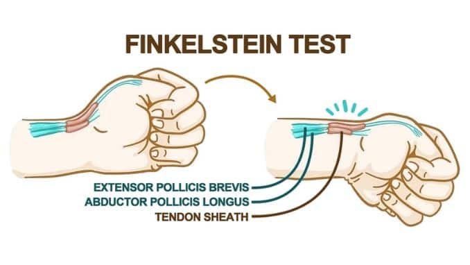 Finkelstein Test